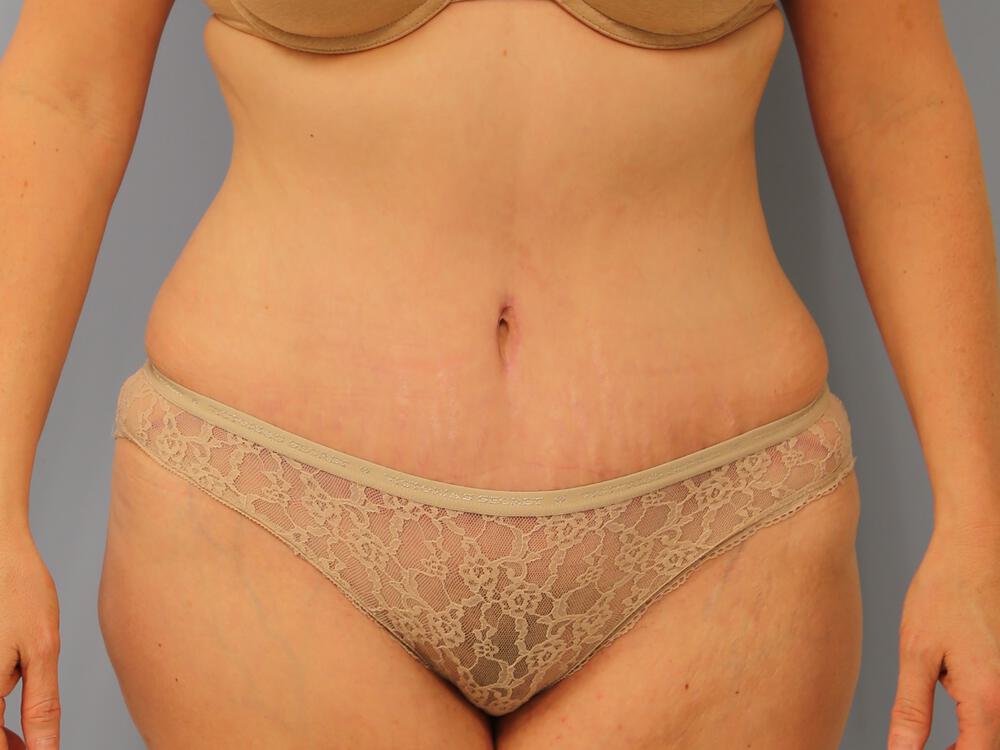 Tummy tuck Before & After Image