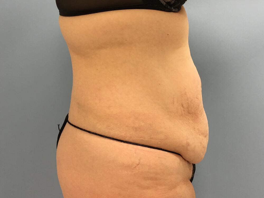 Tummy tuck Before & After Image