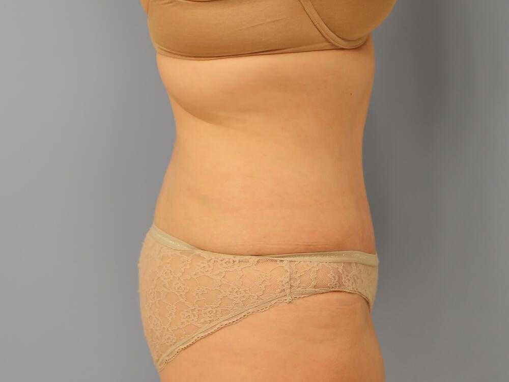 Tummy tuck Before & After Image