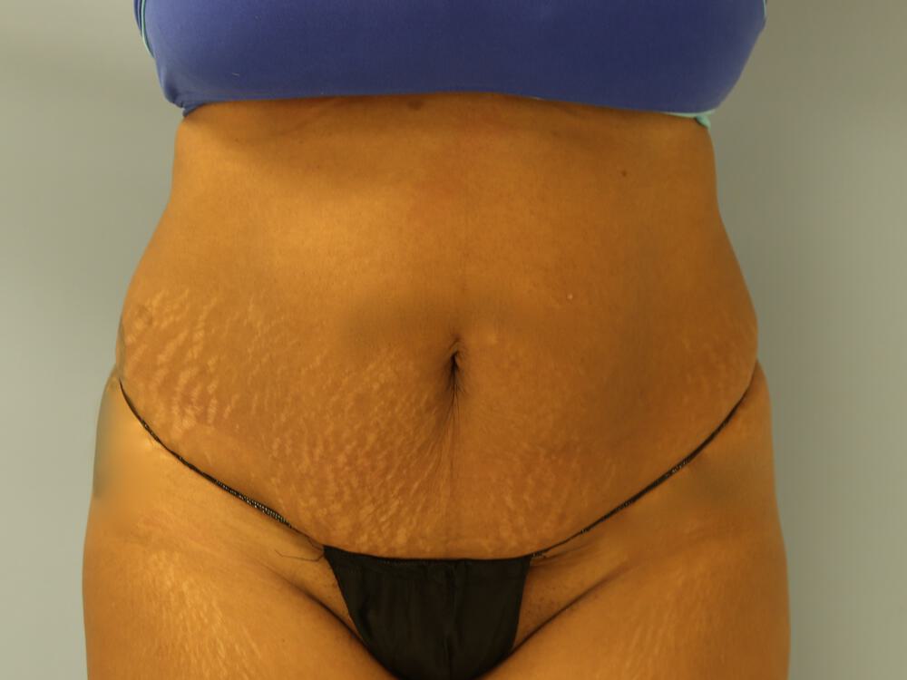 Tummy tuck Before & After Image