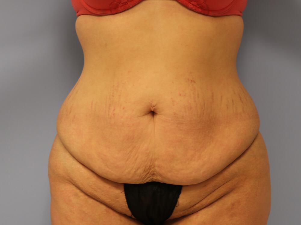 Tummy tuck Before & After Image