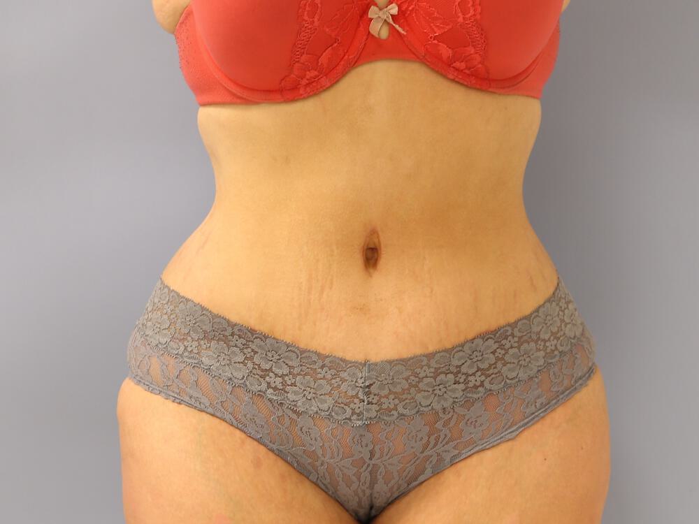 Tummy tuck Before & After Image