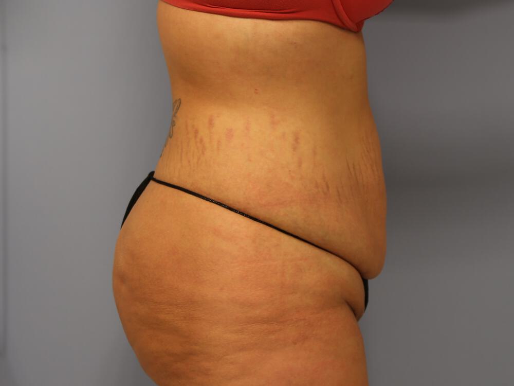 Tummy tuck Before & After Image