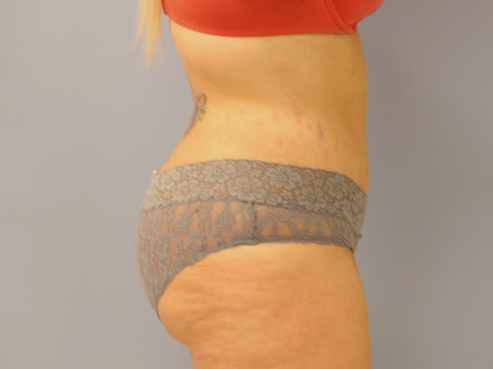 Tummy tuck Before & After Image