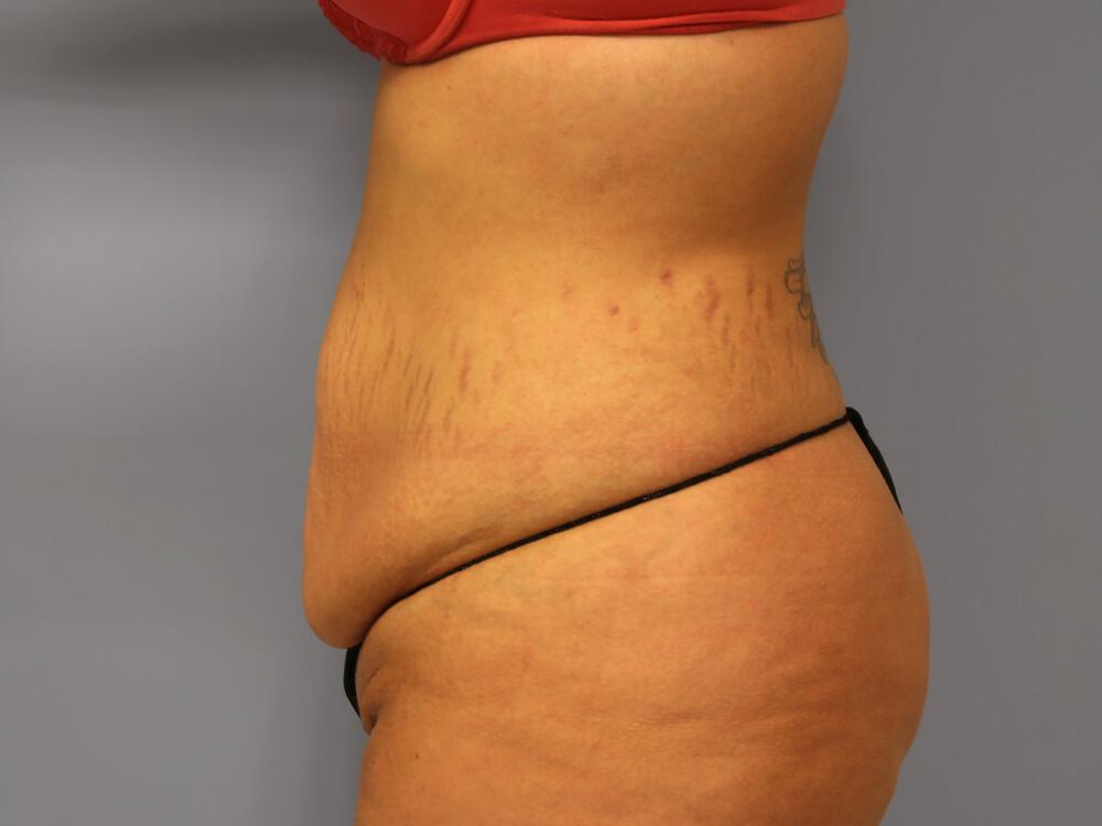 Tummy Tuck Before & After Image