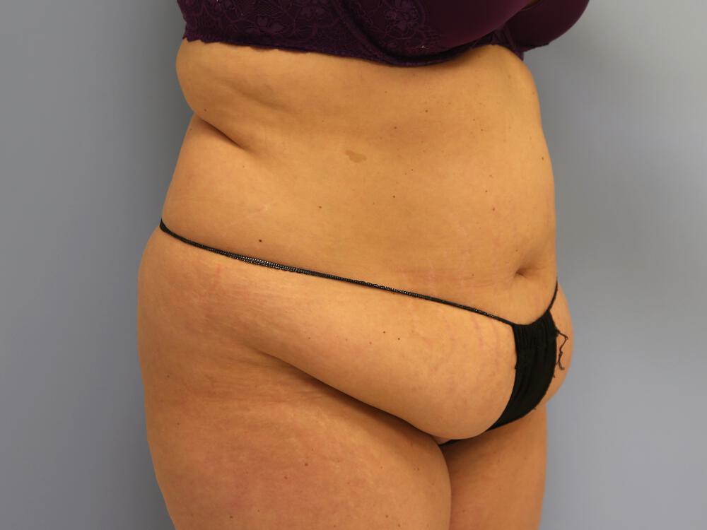 Tummy tuck Before & After Image