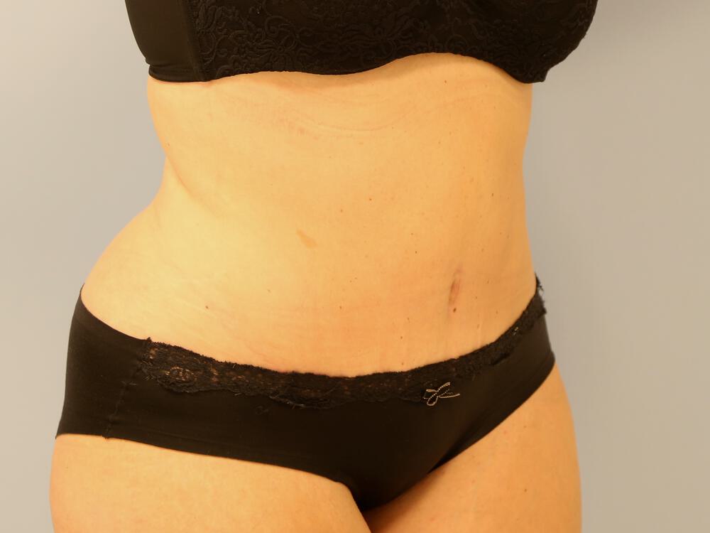 Tummy tuck Before & After Image