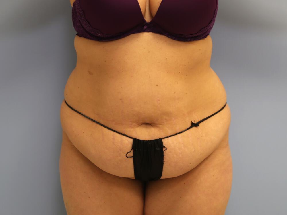 Tummy tuck Before & After Image