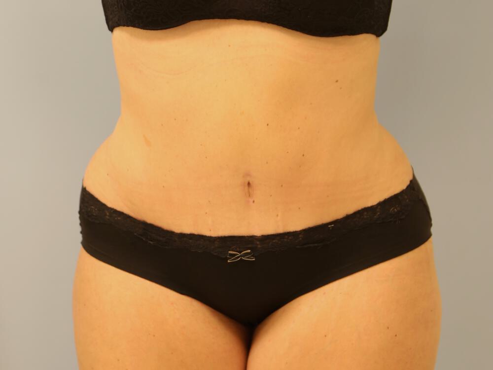 Tummy tuck Before & After Image