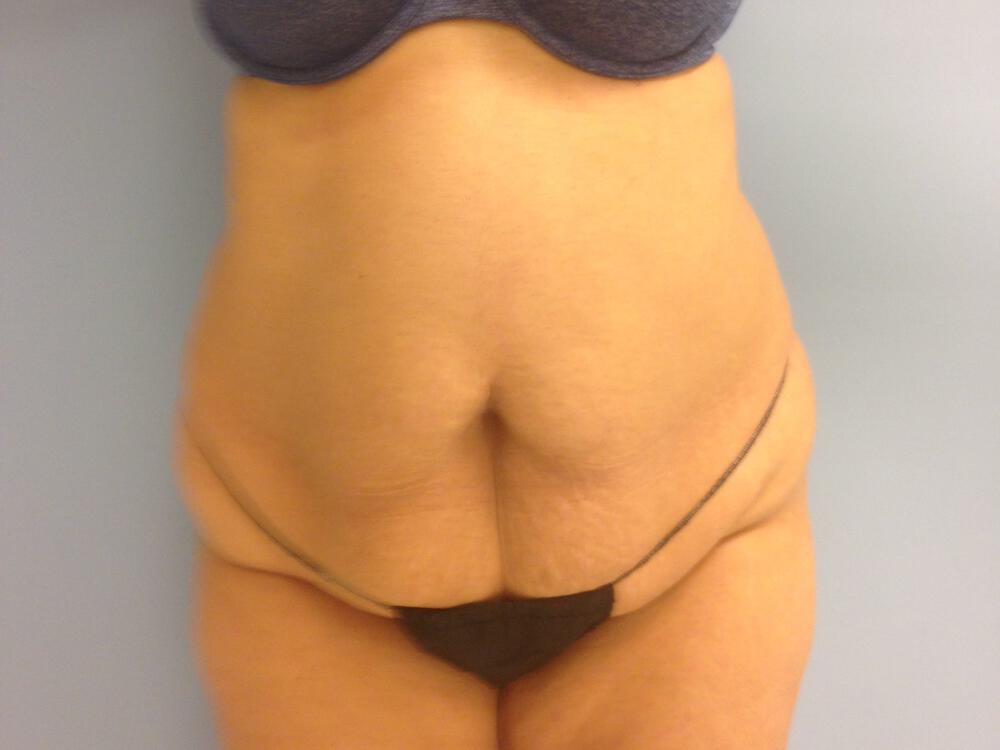 Tummy tuck Before & After Image
