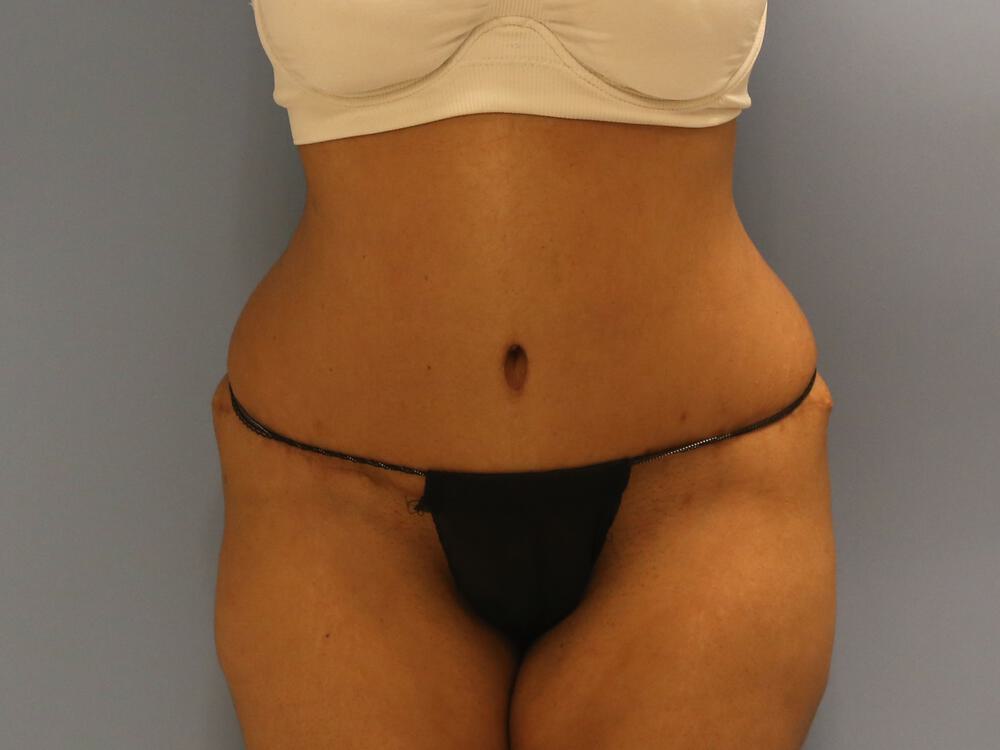 Tummy tuck Before & After Image