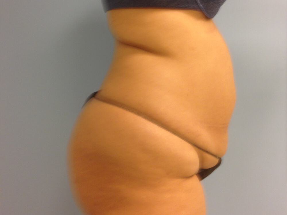 Tummy tuck Before & After Image