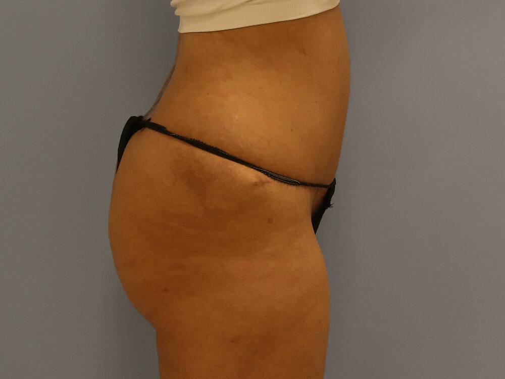 Tummy tuck Before & After Image
