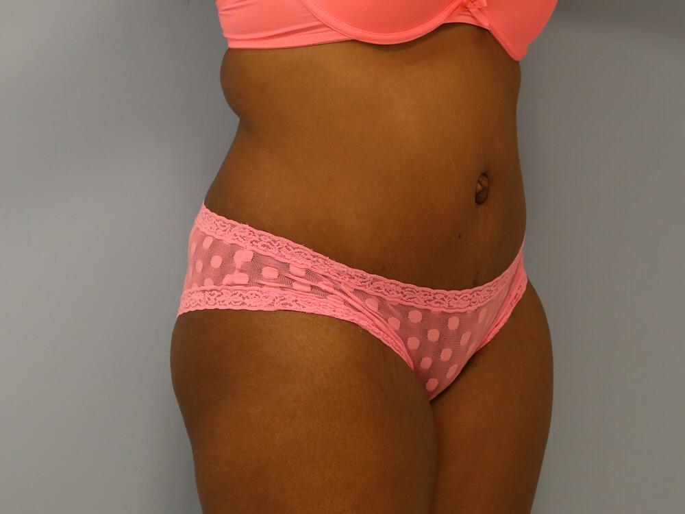 Tummy tuck Before & After Image