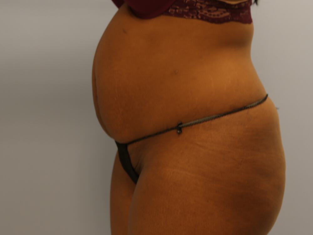 Tummy tuck Before & After Image