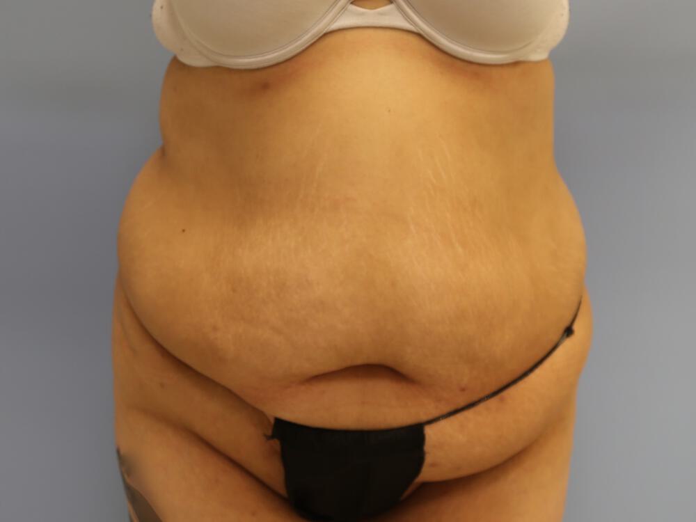 Tummy tuck Before & After Image