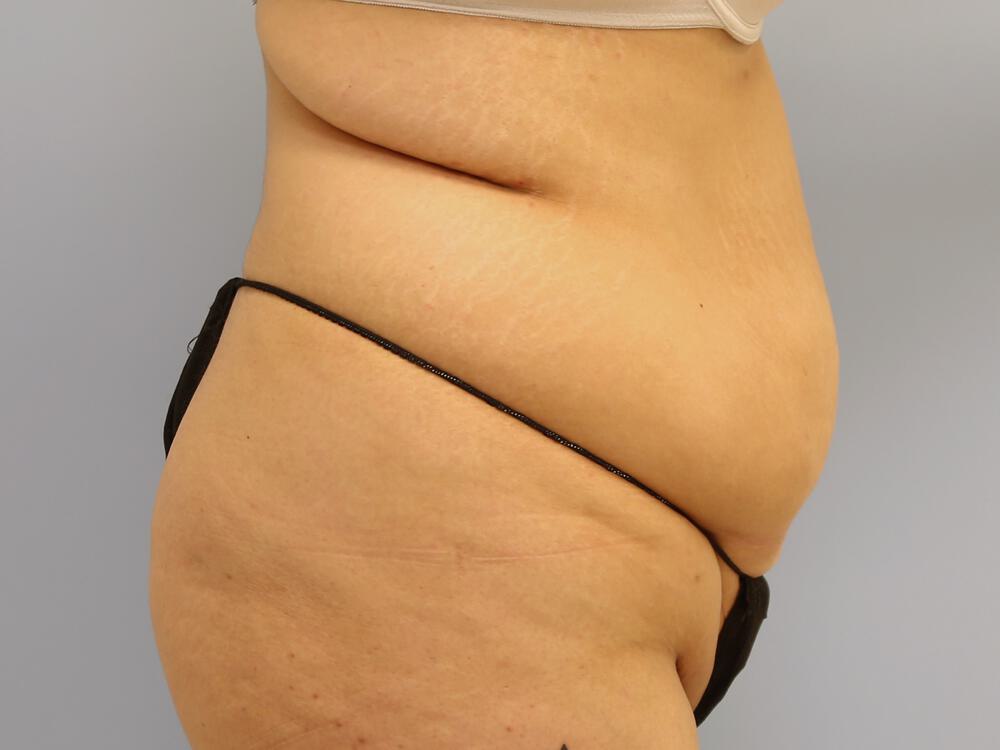 Tummy tuck Before & After Image
