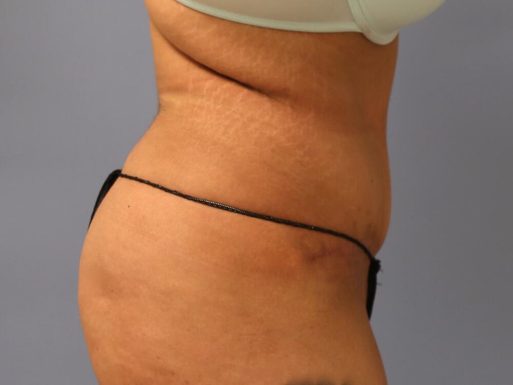 Tummy tuck Before & After Image