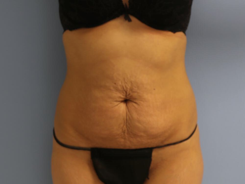 Tummy tuck Before & After Image