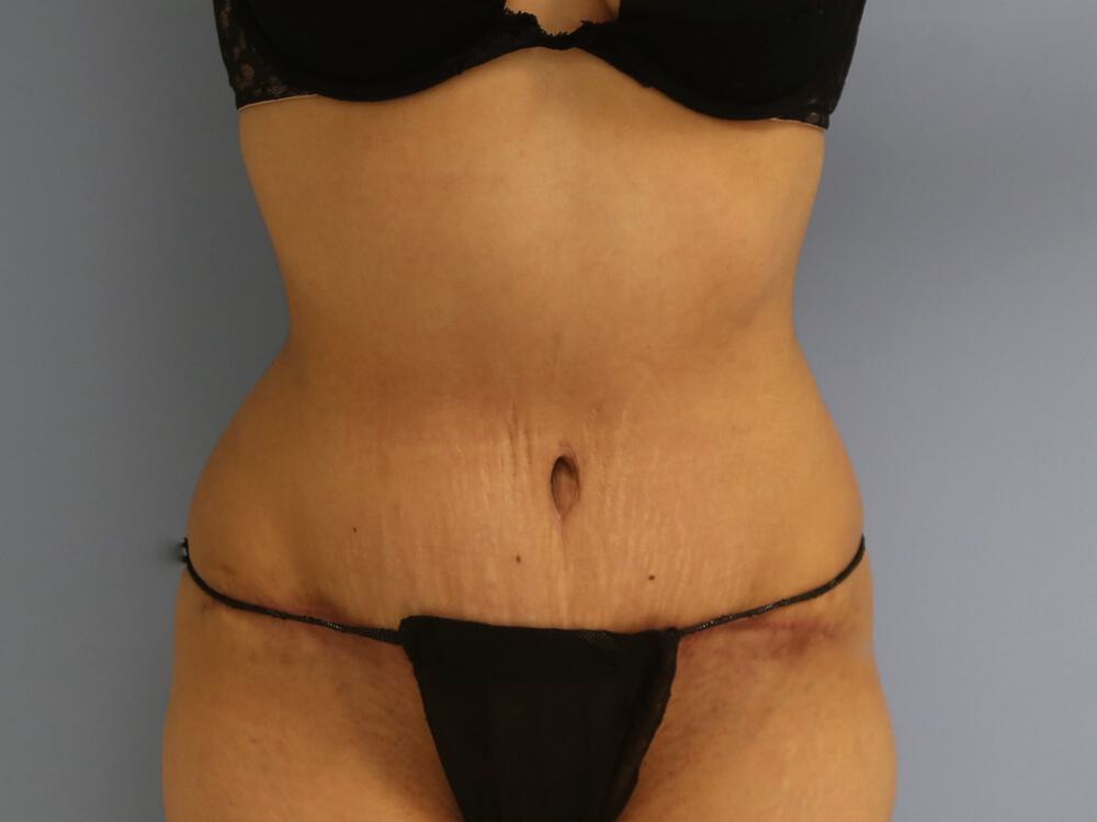 Tummy tuck Before & After Image
