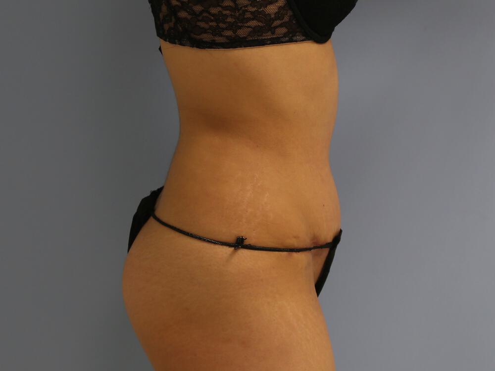 Tummy tuck Before & After Image