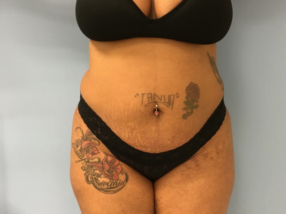 Tummy tuck Before & After Image