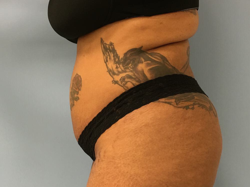 Tummy tuck Before & After Image