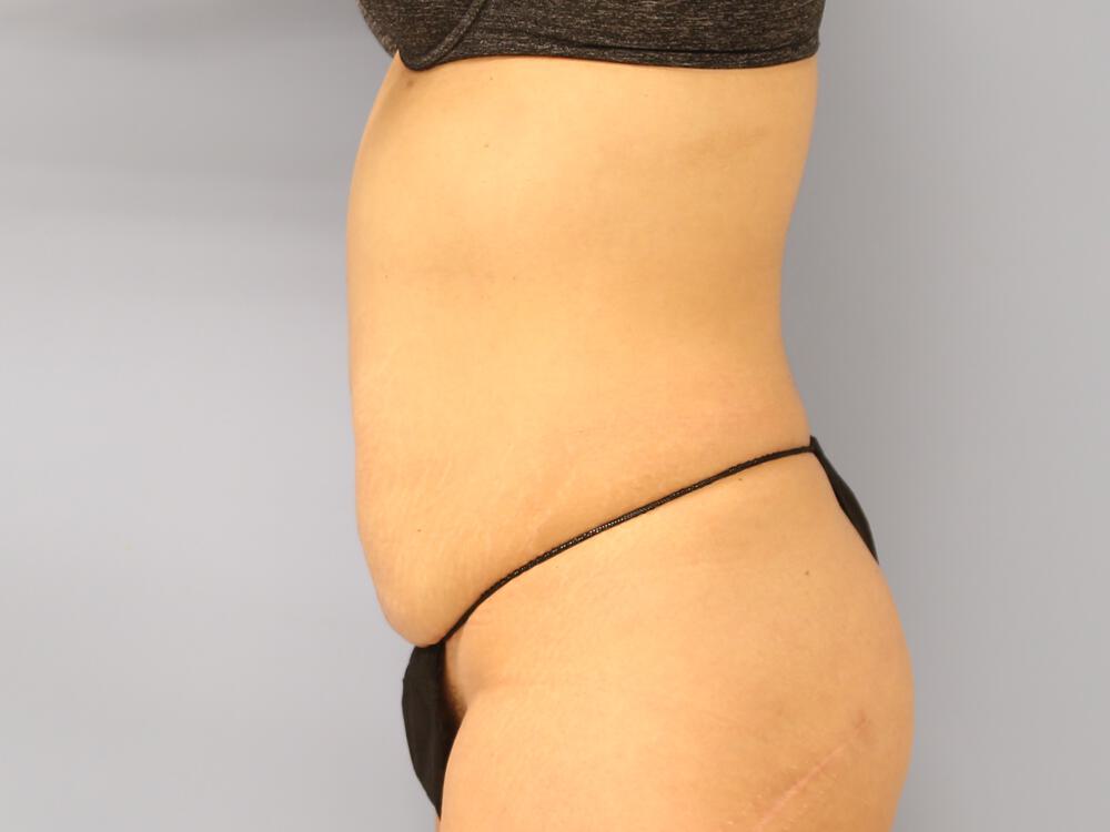 Tummy tuck Before & After Image