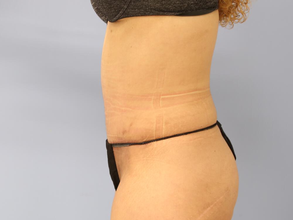 Tummy tuck Before & After Image