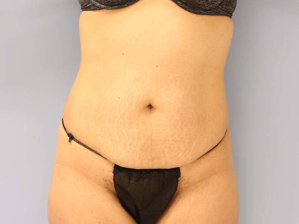 Tummy tuck Before & After Image