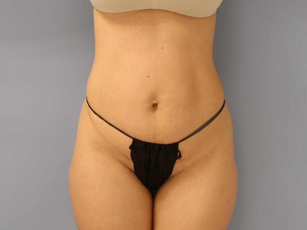 Tummy tuck Before & After Image