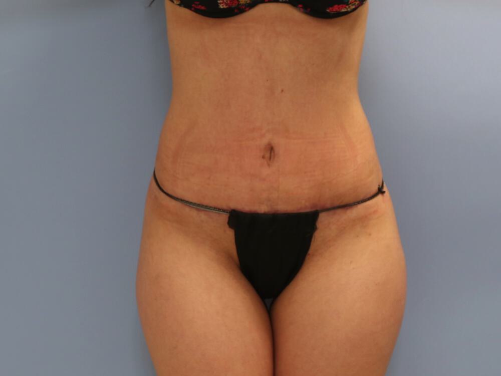 Tummy tuck Before & After Image