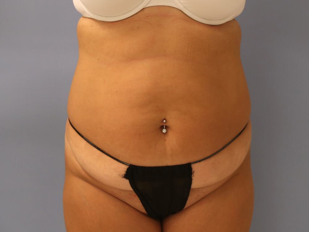 Tummy tuck Before & After Image