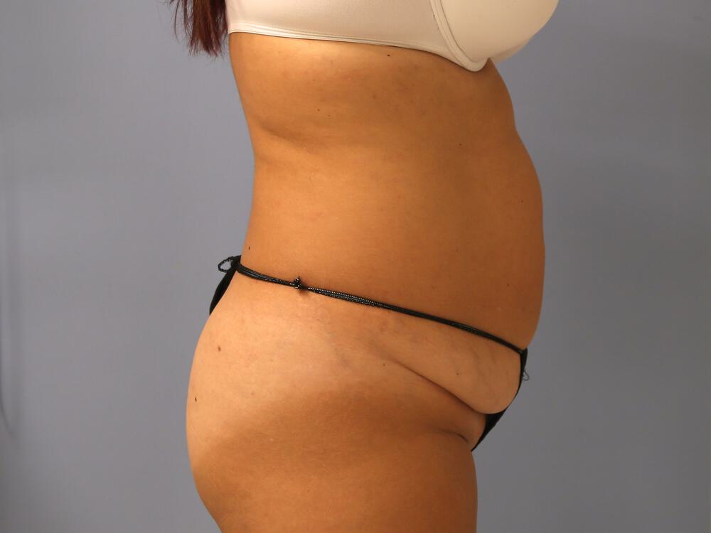 Tummy Tuck Before & After Image
