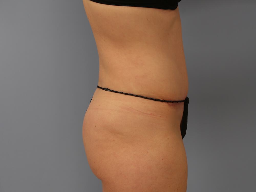 Tummy tuck Before & After Image