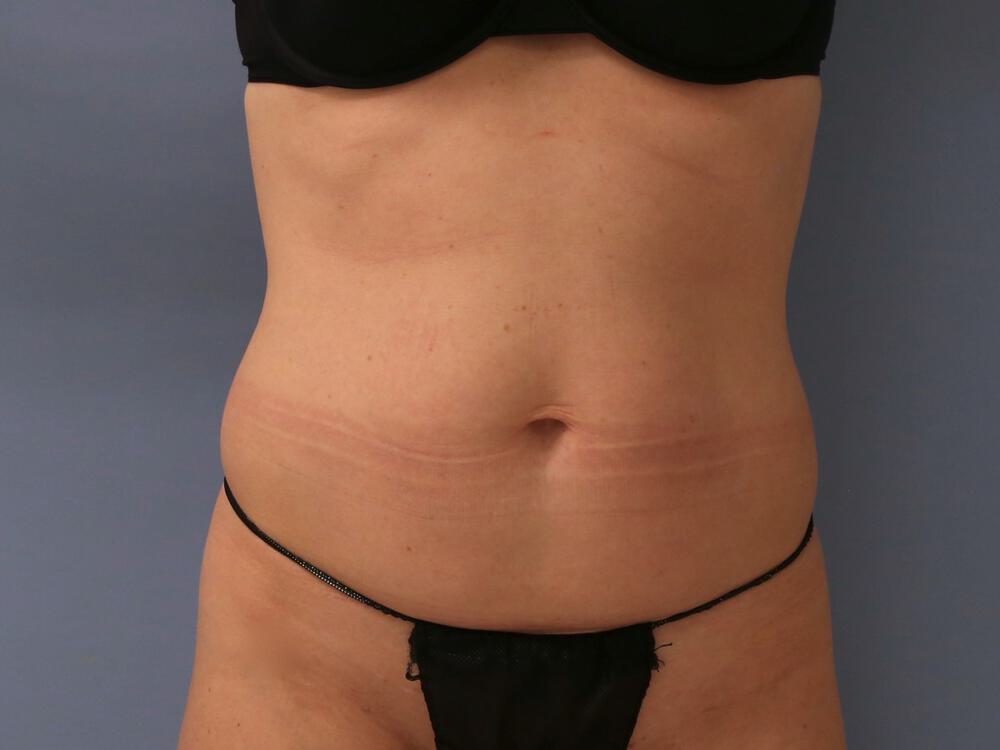 Tummy tuck Before & After Image