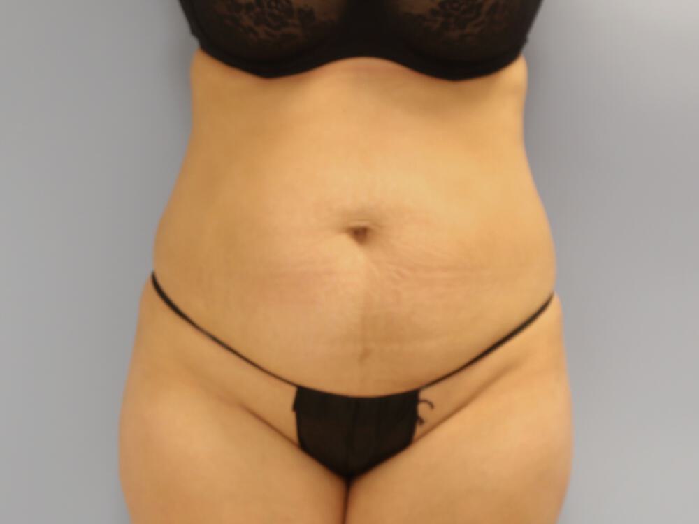 Tummy tuck Before & After Image