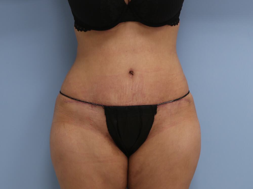 Tummy tuck Before & After Image