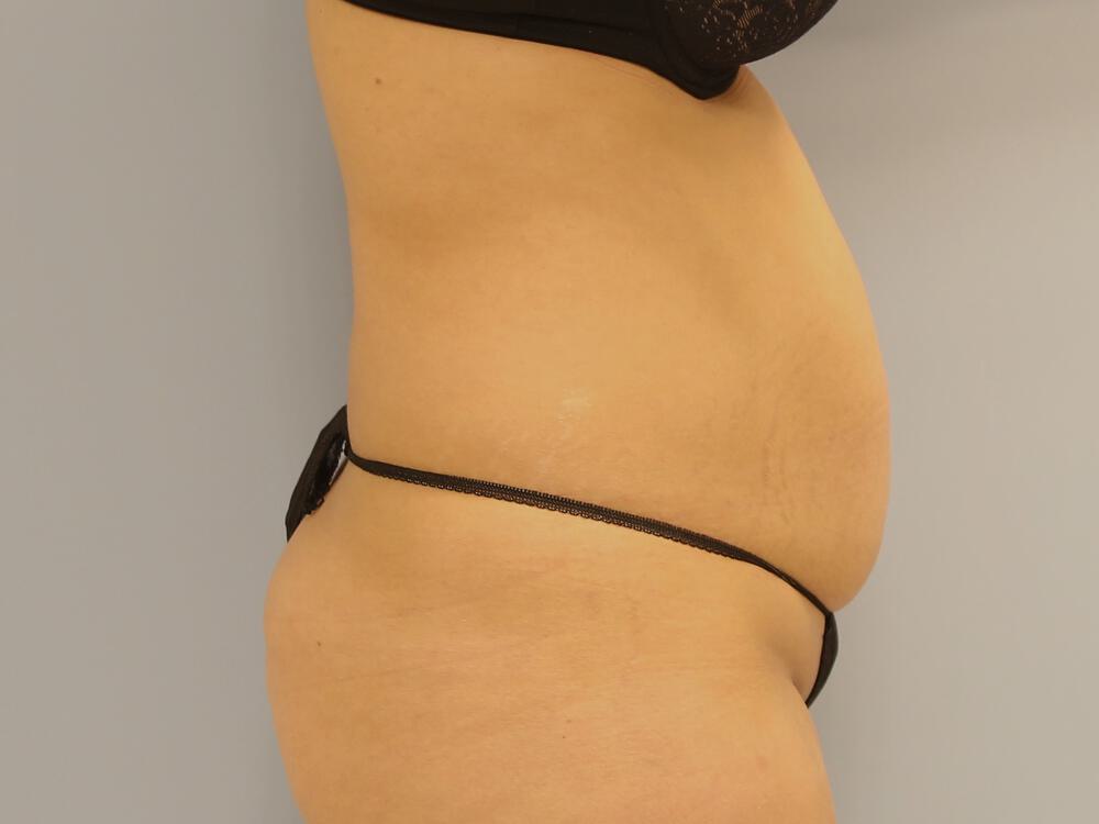 Tummy tuck Before & After Image