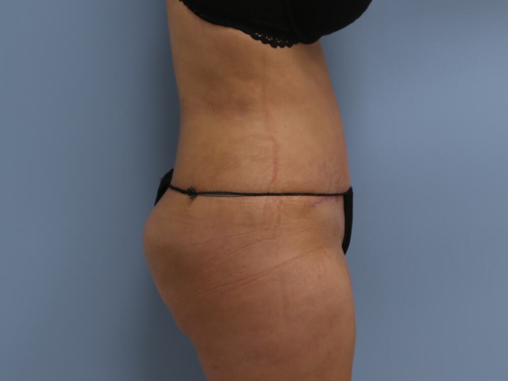 Tummy tuck Before & After Image