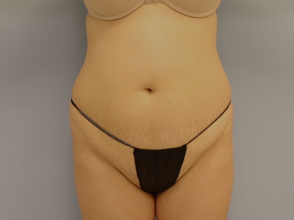 Tummy tuck Before & After Image