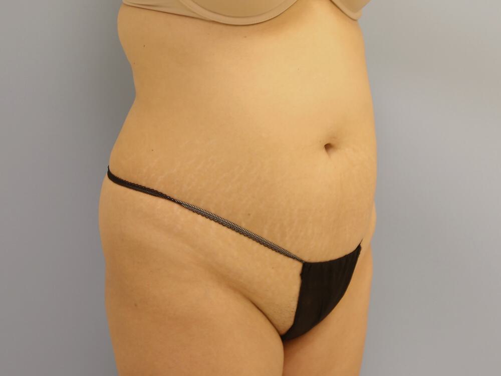 Tummy tuck Before & After Image