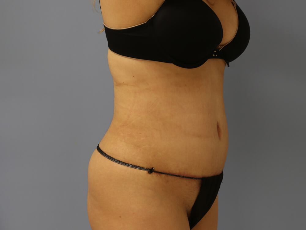 Tummy tuck Before & After Image