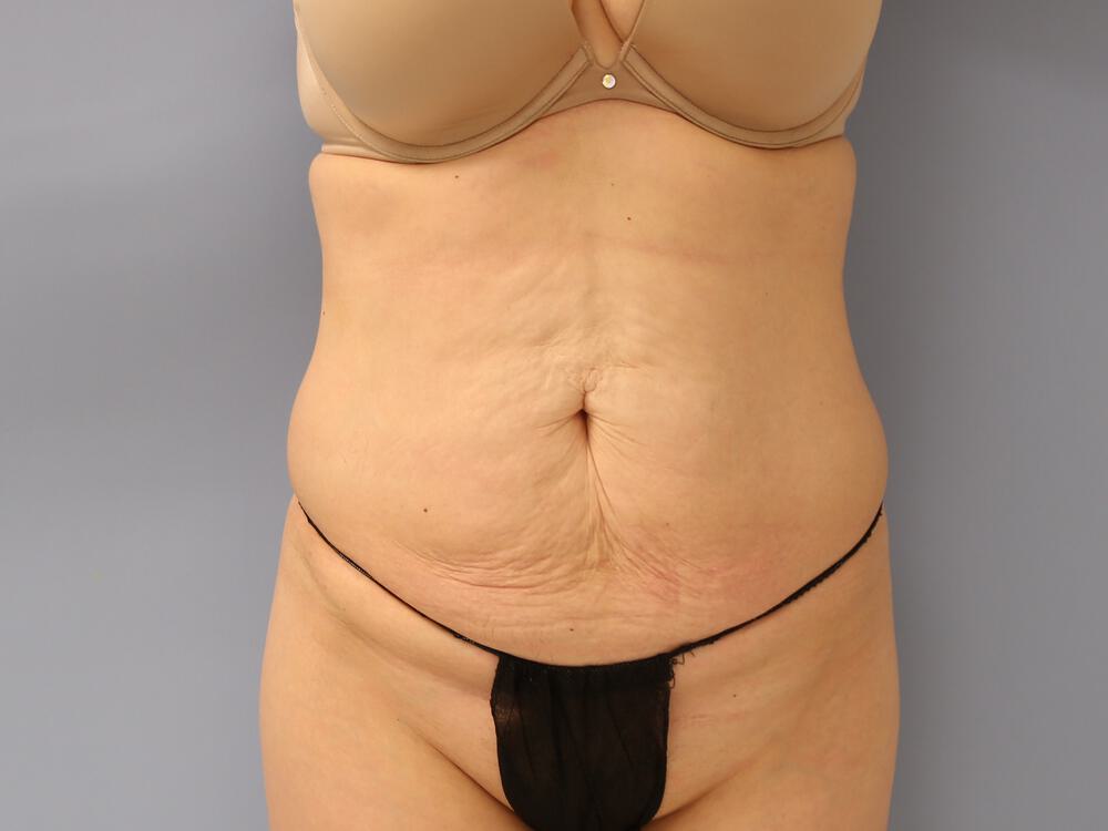 Tummy tuck Before & After Image