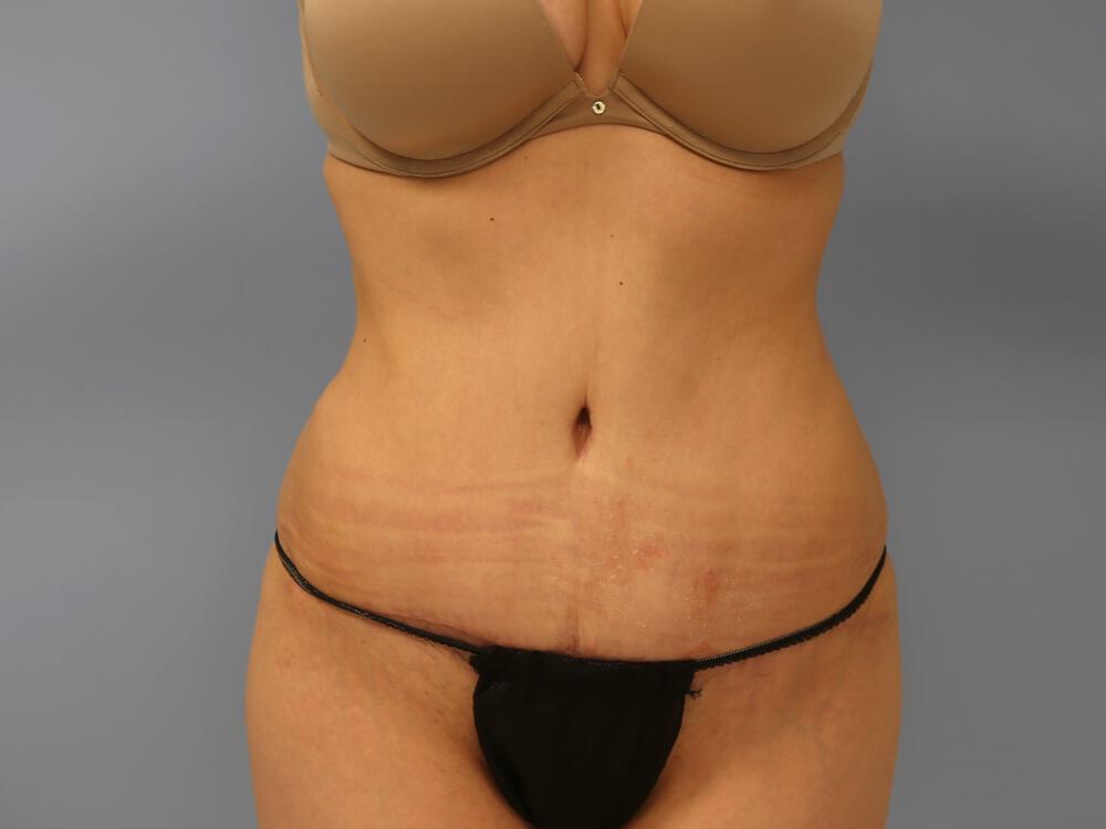 Tummy tuck Before & After Image