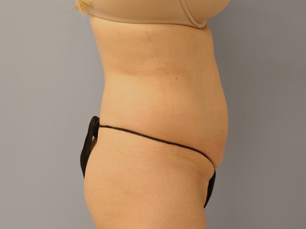 Tummy tuck Before & After Image