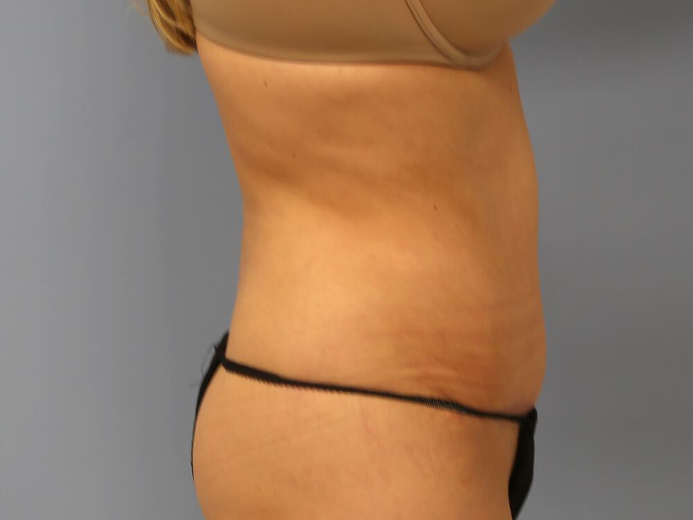 Tummy tuck Before & After Image