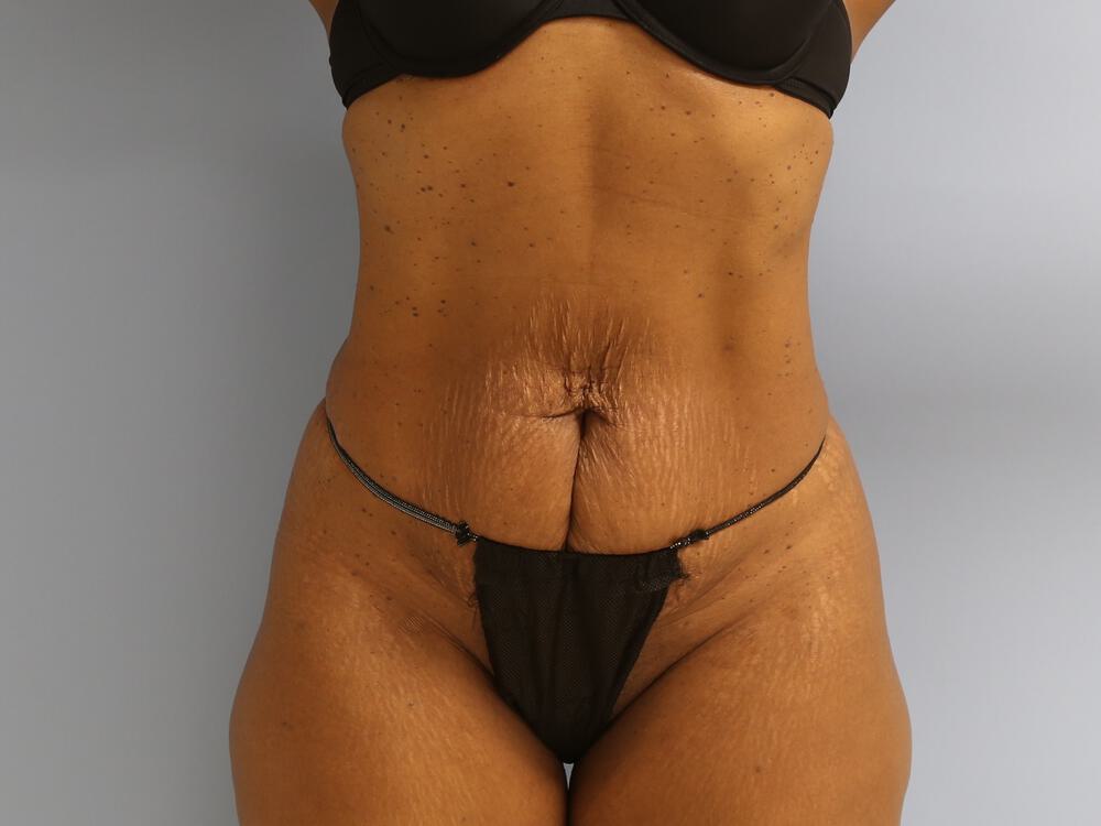 Tummy tuck Before & After Image