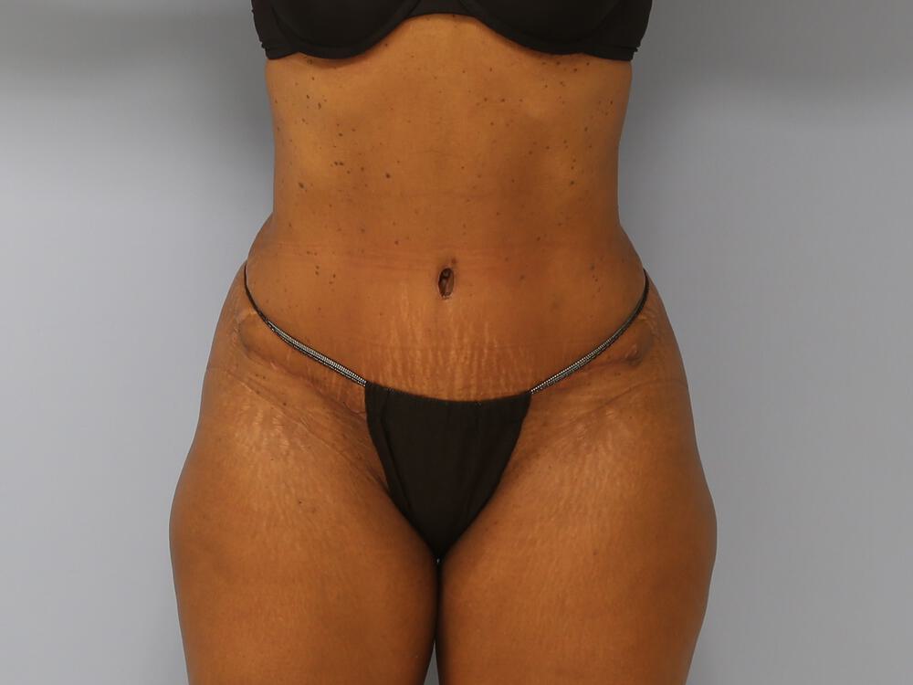 Tummy tuck Before & After Image