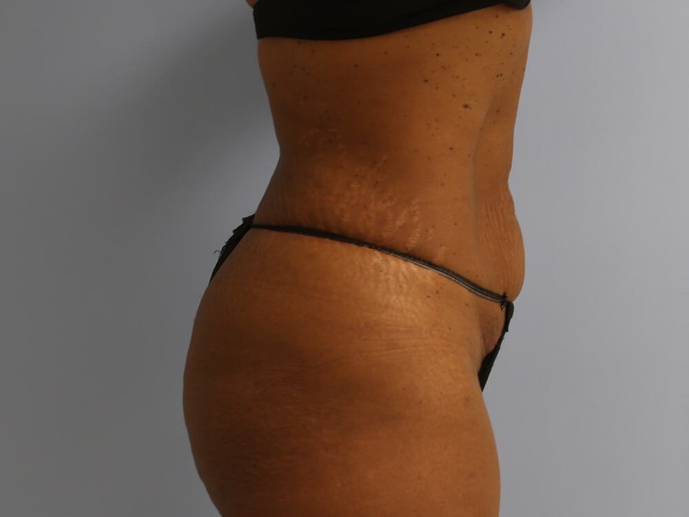 Tummy tuck Before & After Image